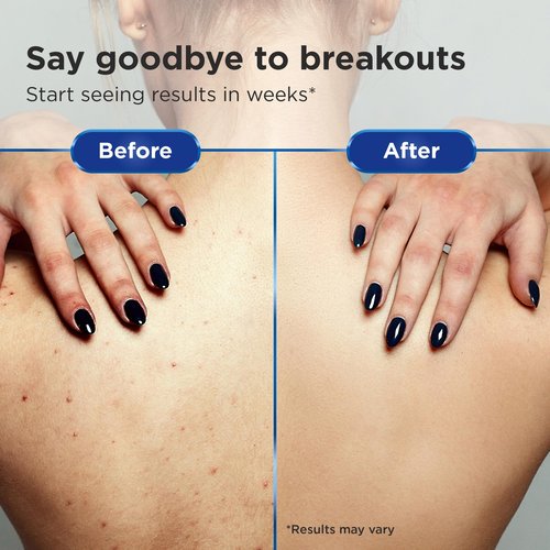 CLEAR 2 PERFECTION Acne Treatment Kit - Non-Comedogenic Haircare & Skincare Trio - Scrub, Shampoo & Conditioner - Ideal for Acne-Prone Skin & Bacne