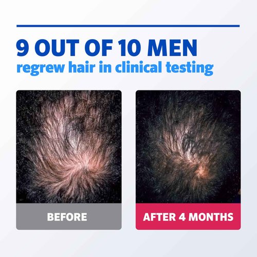 Rogaine Men’s 5% Minoxidil Foam Hair Regrowth Treatment, FDA Approved Brand, Proven to Improve Hair Regrowth, Extra Strength Minoxidil Foam, Unscented Aerosol, 4 Month Supply (4 x 2.11 oz Cans)