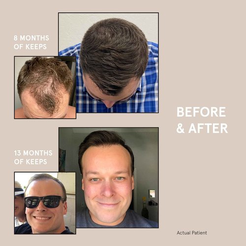 Keeps Starter Bundle - Includes Minoxidil Topical Hair Growth Solution, Hair Thickening Shampoo & Conditioner Set