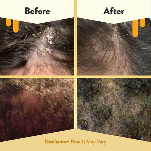 ECZEMA HONEY Scalp Kit - Natural Anti Dandruff Shampoo, Conditioner, & Scalp Oil for Flakes - Argan Oil & Tea Tree Oil for Hair - Eczema Treatment Helps Psoriasis, Seborrheic Dermatitis, & More