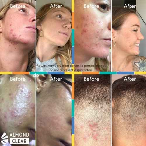 Almond Clear Oily Skin Kit | Skin Care Kit for Oily Skin, Acne & Folliculitis - Includes Face & Body Wash, Facial Acne Serum, and Gel Moisturizer