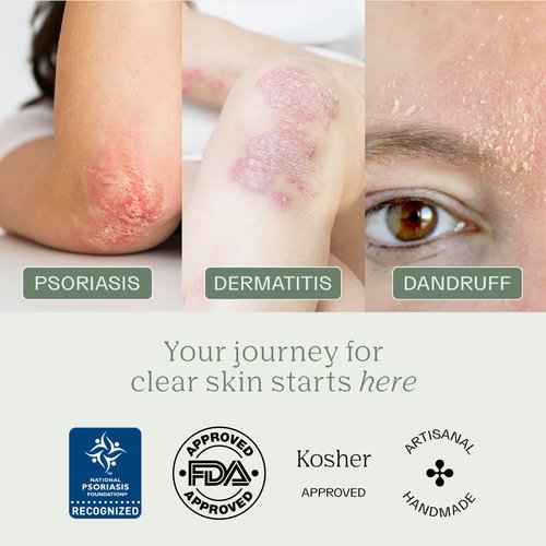 Dermabon Seborrheic Dermatitis Cream & Psoriasis Soap Bar Bundle| Calendula Extract, Salicylic Acid & Bee Wax Cream| Coal Tar soap for Dandruff Control| Moisturizing Crema para Psoriasis