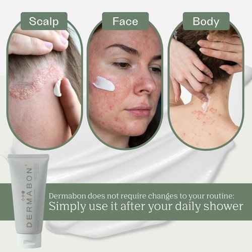 Dermabon Seborrheic Dermatitis Cream & Psoriasis Soap Bar Bundle| Calendula extract, Salicylic acid & Bee wax cream| Coal tar soap for Dandruff control| Moisturizing Crema Para Psoriasis