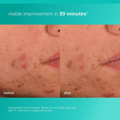 Dermalogica Acne Biotic Face Moisturizer, Lightweight Daily Lotion - Helps with Aging Skin and Prevents Breakouts, 1.7 fl oz