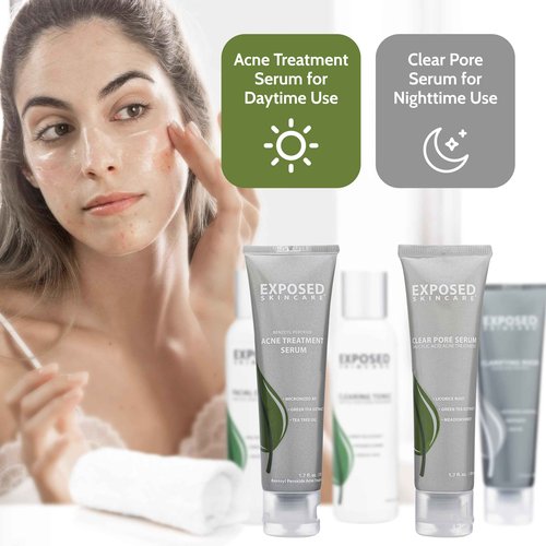 Exposed Skin Care, Acne Treatment Kit with 2.5% Salicylic Acid and 3.5% Benzoyl Peroxide to Clear Up Teen, Adult, Hormonal and Cystic Acne – Natural, Non-toxic and Cruelty Free