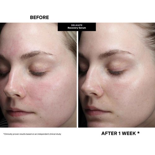 Kate Somerville DeliKate Recovery Serum – Clinically Formulated Hydrating Treatment, Irritation and Redness Relief for Stressed or Sensitive Skin, 1 Fl Oz