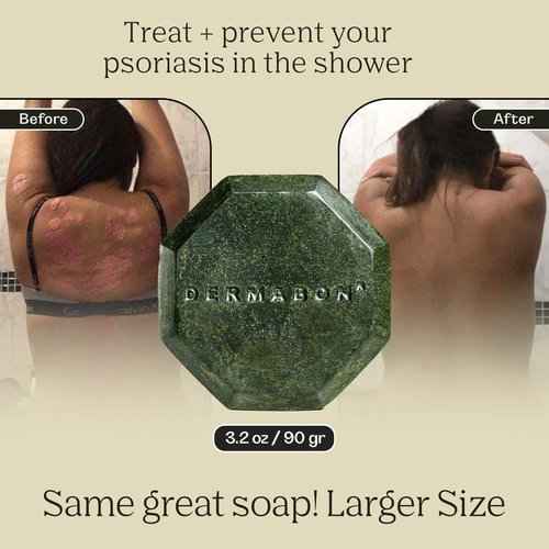 Dermabon Seborrheic Dermatitis Cream & Psoriasis Soap Bar Bundle| Calendula extract, Salicylic acid & Bee wax cream| Coal tar soap for Dandruff control| Moisturizing Crema Para Psoriasis