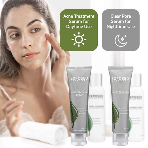 Exposed Skin Care, Basic Acne Treatment Kit with 2.5% Salicylic Acid and 3.5% Benzoyl Peroxide to Clear Up Teen, Adult, Hormonal and Cystic Acne – Natural, Non-toxic and Cruelty Free