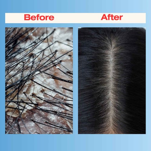 Therapro Mediceuticals Scalp Treatment - 3 Piece Kit (for Dandruff & Psoriasis)