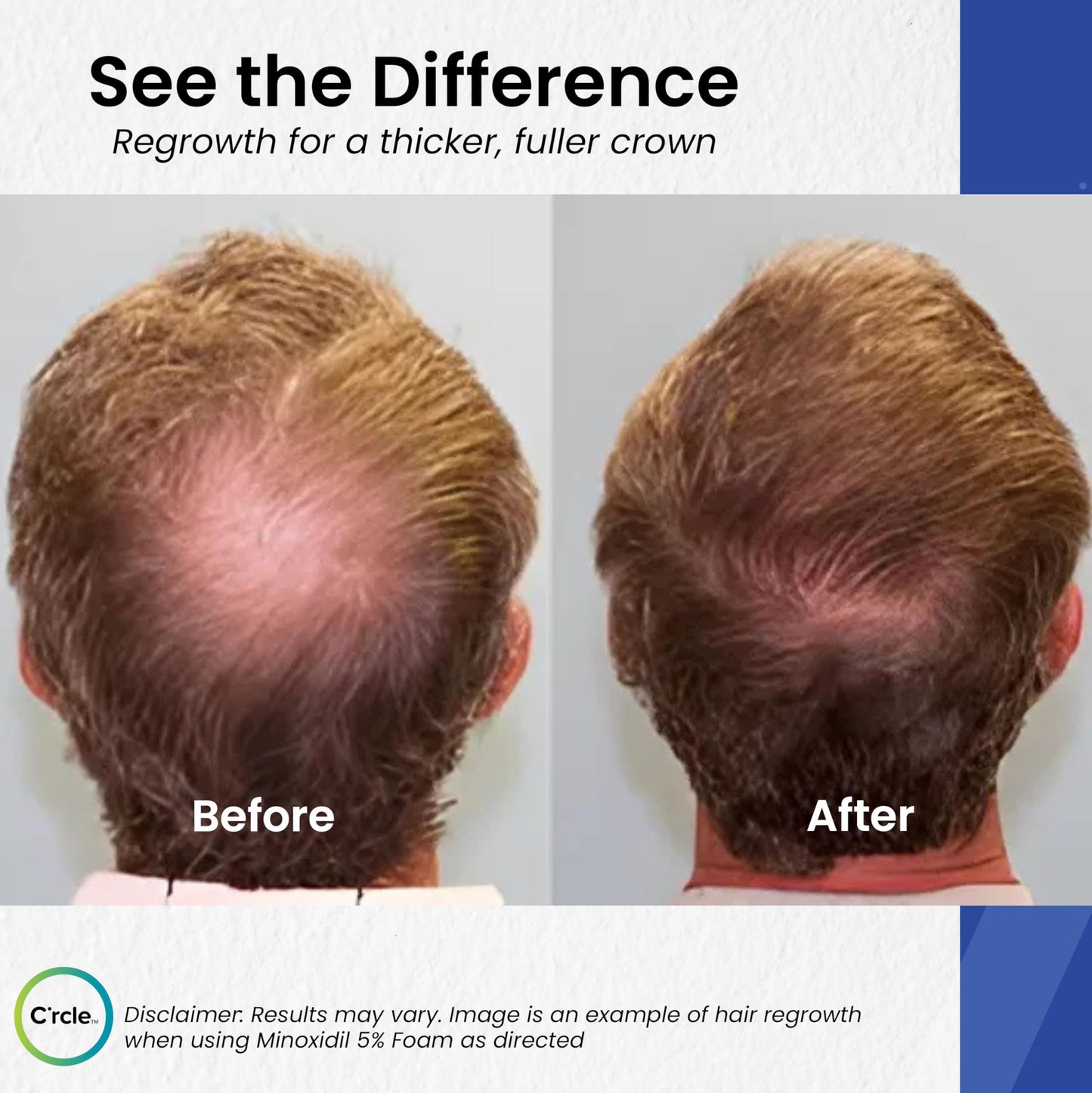 Minoxidil for Men Foam 5% - Unscented 6 Month Supply - Helps Restore Vertex Hair Loss & Thinning - 5% Minoxidil Foam For Men - Extra Strength Supports Hair Regrowth