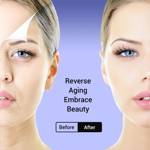 SOZOOM PDO Screw Threads, PDO Thread Lift KOREA Pdo Threads Whole Body Lifting (100PCS-29G-38mm)