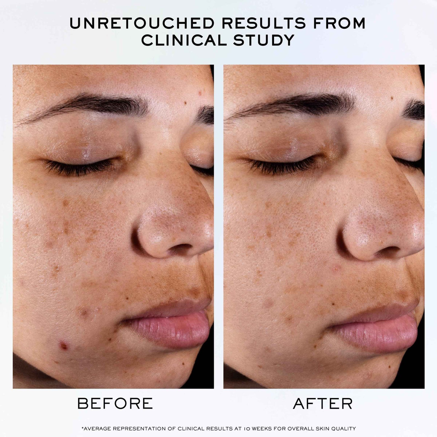 Lancôme Clarifique Pro-Solution Face Serum - Facial Serum For Visibly Reducing Dark Spots & Acne Spots - With 10% PHA and Niacinamide - 1.0 Fl Oz