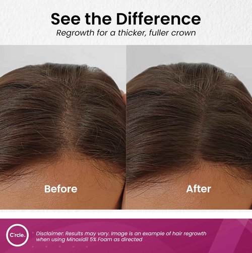 C'rcle Minoxidil for Women 5% Foam - Helps Restore Top of Scalp Hair Loss and Support Hair Growth for Women, Regrowth with Unscented Topical Treatment for Thinning Hair (5% Foam 8-Month Supply)