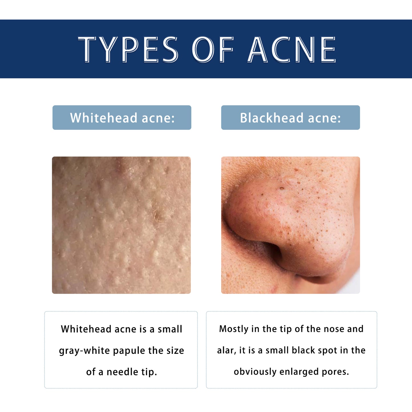 Anti-Pimple Drying Lotion with Salicylic Acid - Acne Spot Treatment
