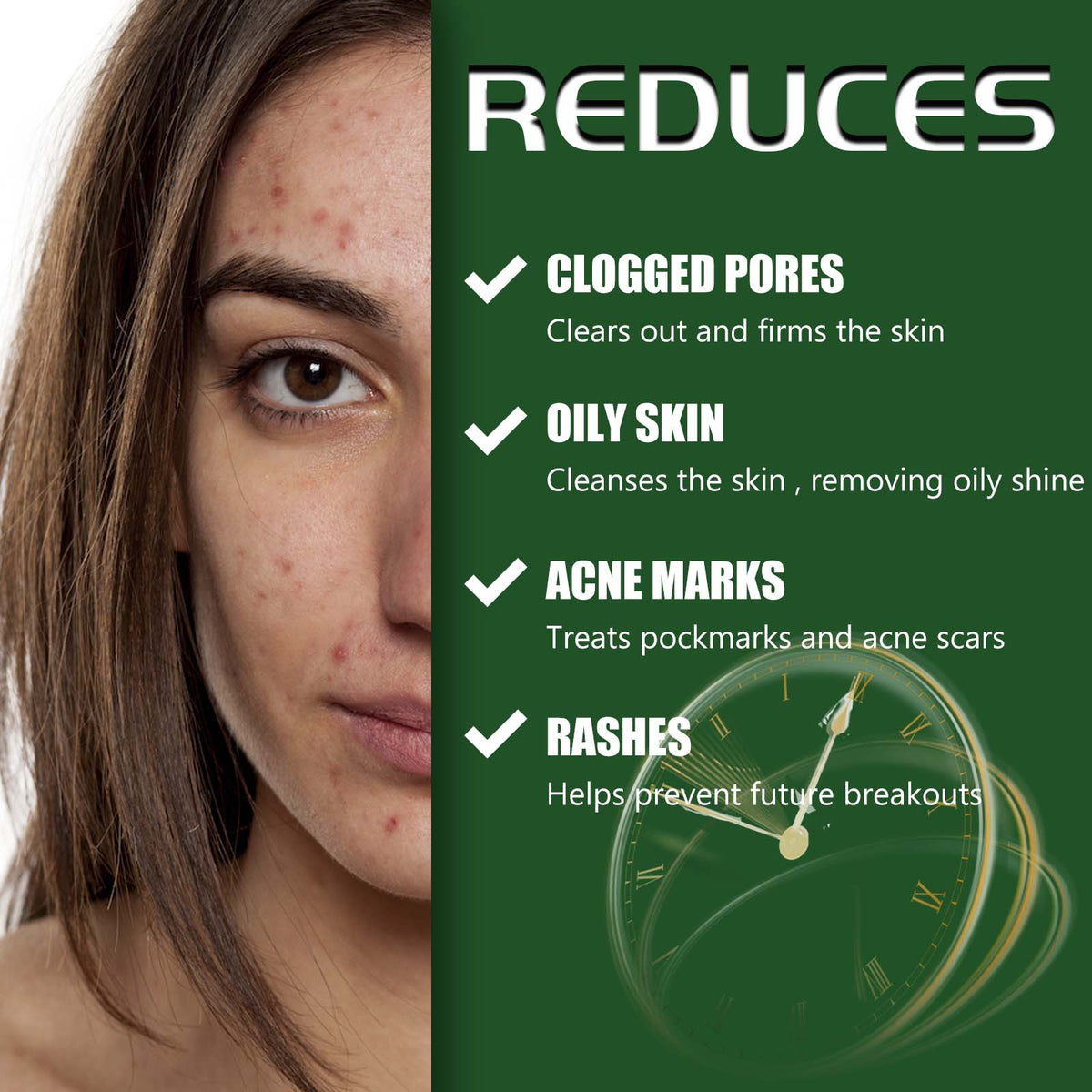 Acne Spot Treatment Cream with Tea Tree Oil - 30g Facial Acne Care