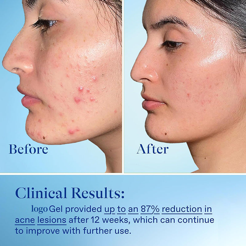 Freckle Removal Acne Gel - 15g Facial Skin Care Treatment