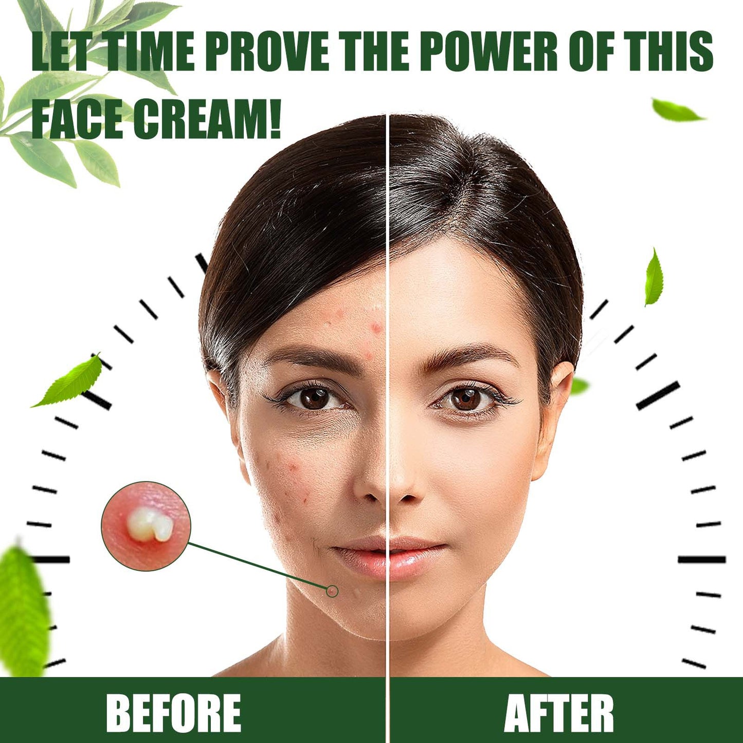 Acne Spot Treatment Cream with Tea Tree Oil - 30g Facial Acne Care