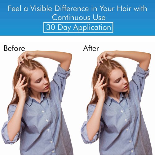 MD suero natural para el crecimiento del cabello | Follicle Energizer Serum: evita el adelgazamiento del cabello y la pérdida de cabello al estimular los folículos capilares para producir un ca