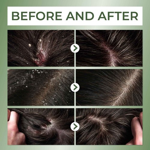 ABERA High-Performance Anti-Dandruff Shampoo with Langbian Ginseng Extract, Sulfate Free Paraben Free, 5,07 Fl Oz |2 Box + Free 1 Hair Growth Serum|