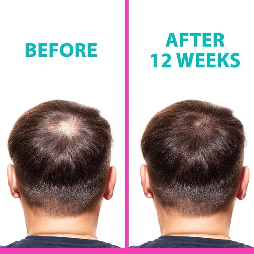 T2 Hair Loss Leave In Vials for Weak and Fine Hair - Natural Growth Oil Scalp Treatment for Women and Men - Intensive Root Strengthening Treatment with Peppermint, Rosemary