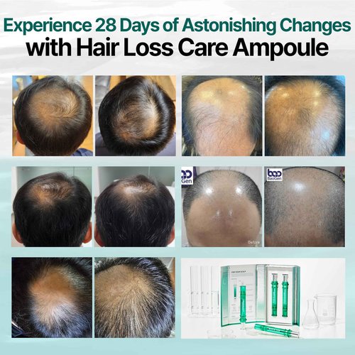BAO_H.LAB Hair Loss Care Ampoule for Hair Thinning & Shedding, Healthier Scalp & Thicker Fuller Looking Hair in One Month Hair Care Solution, Non-oily Non-greasy 2 Ampoules in One Pack Korean Haircare