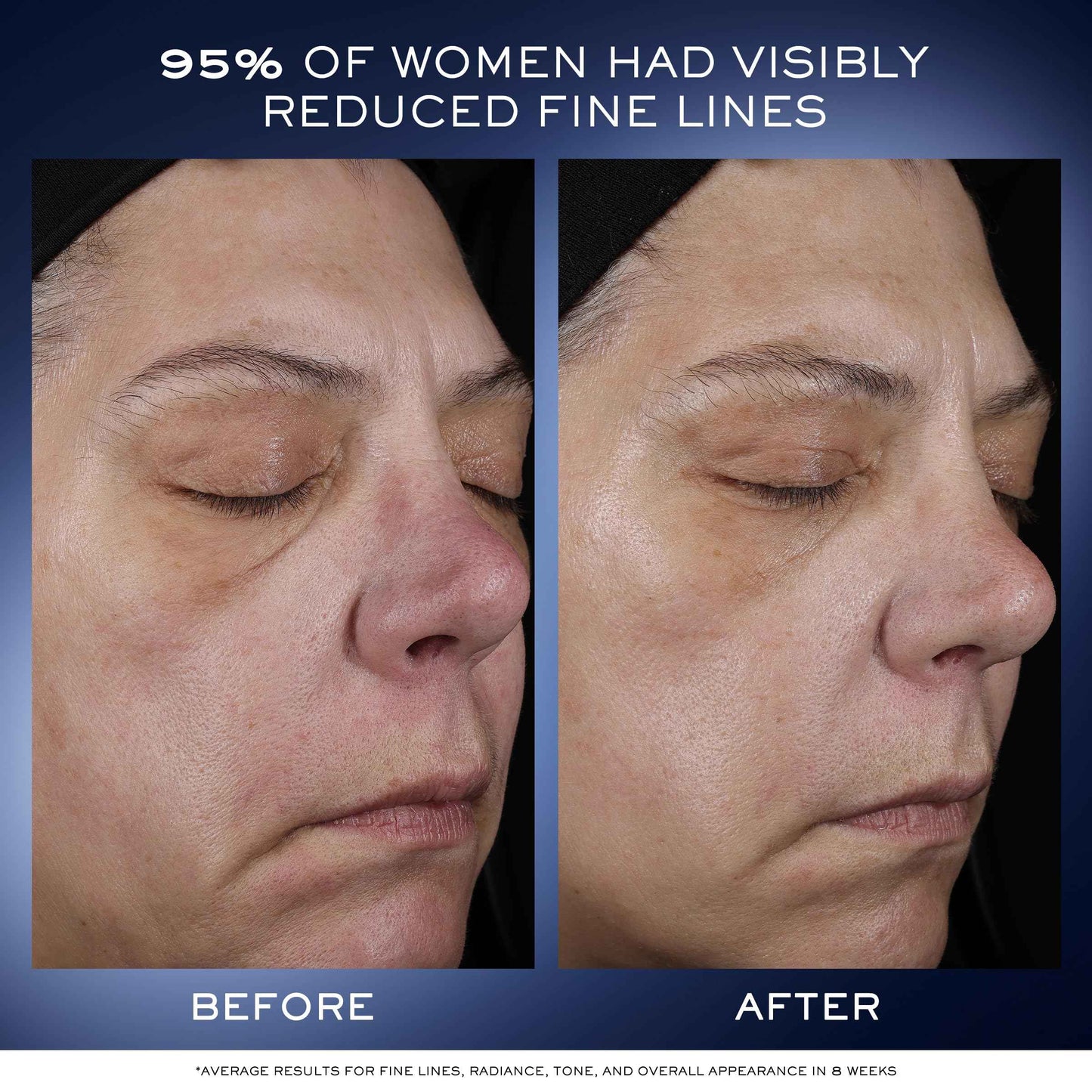 Lancôme Génifique Ultimate Dual Recovery Face Serum- Anti-Aging Serum Visibly Improves Fine Lines, Rough Texture, Plumpness and Even Skintone - with Beta Glucan and, Hyaluronic Acid - 1 Fl Oz