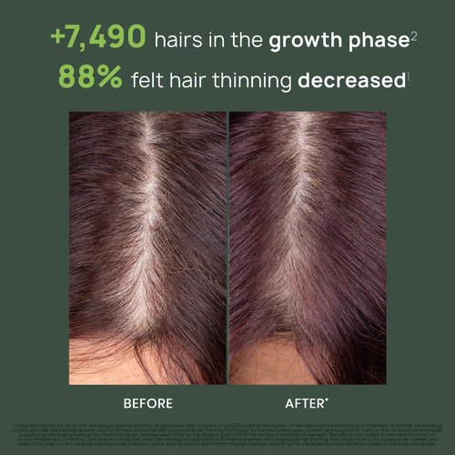 Rene Furterer Triphasic Progressive Concentrated Serum for Hereditary, Hormonal Thinning Hair - Drug-Free - Receding Hairline - Leave-In - Sulfate, Paraben, Silicone-Free - 8 ct., 30-Day Supply