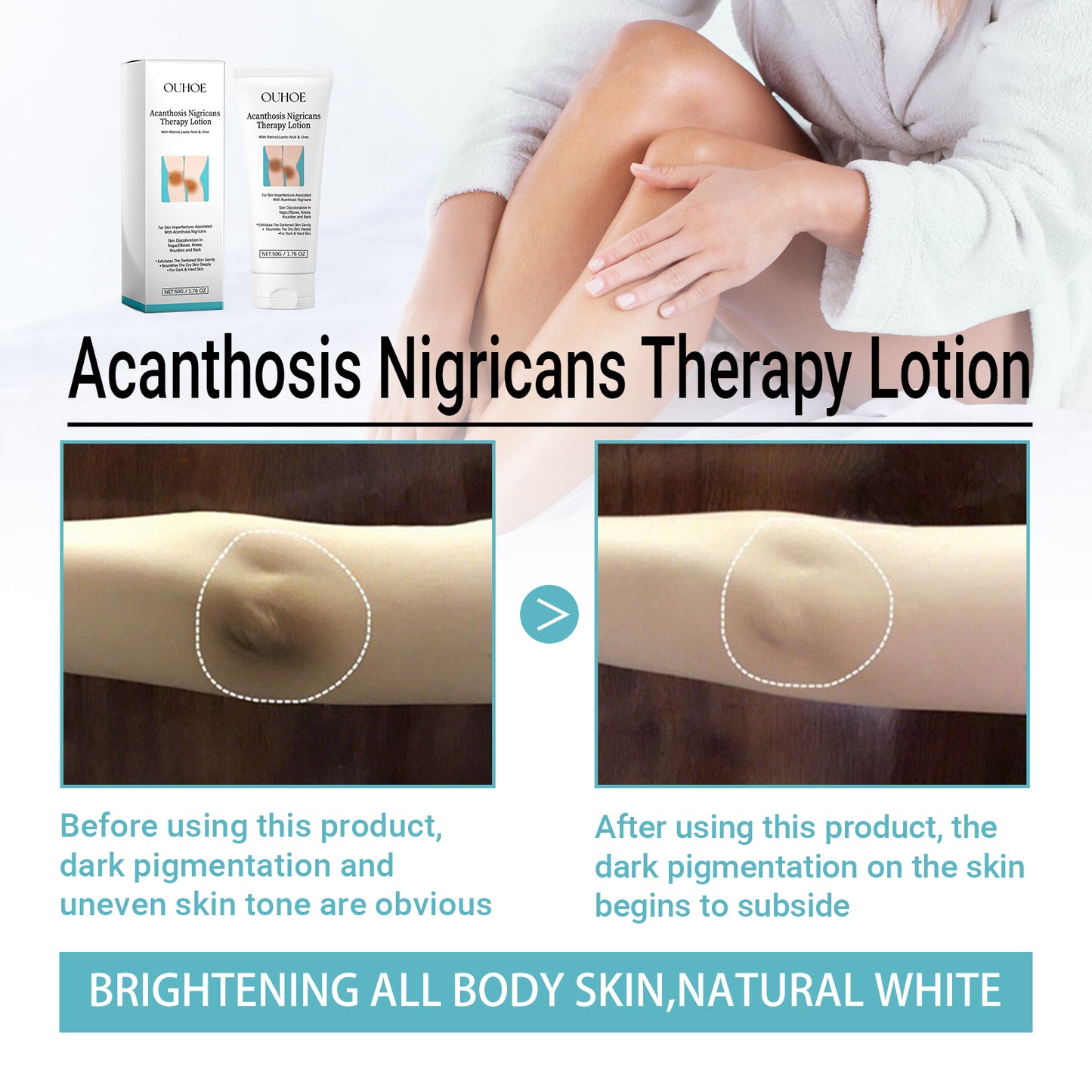 Acanthosis Nigricans Therapy Lotion - Dark Spot Corrector for Skin Repair