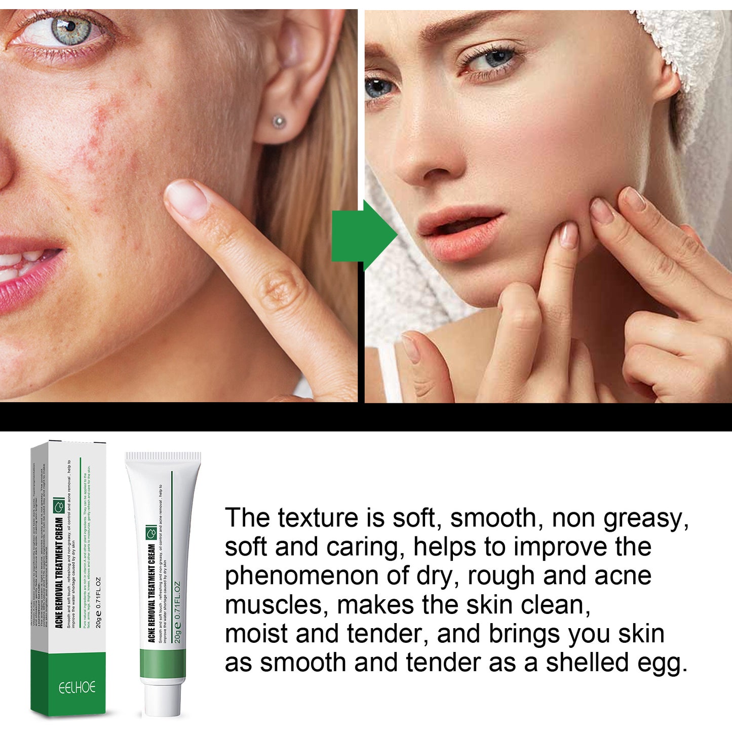 Niacinamide Acne & Blemish Removal Cream - Dark Spot Corrector & Skin Repair