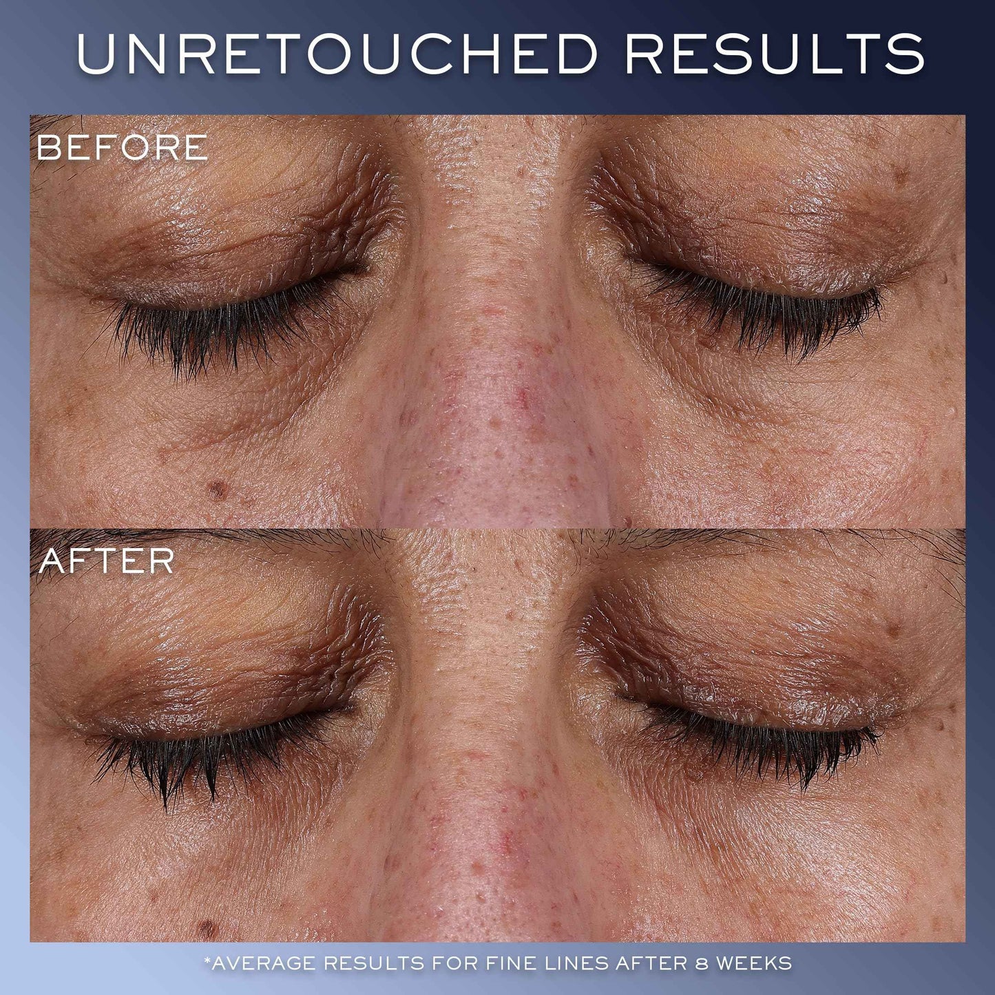 Lancôme Génifique Eye Cream - For Dark Circles & Fine Lines - With Bifidus Prebiotic, Hyaluronic Acid & Vitamin Cg - 0.67 Fl Oz