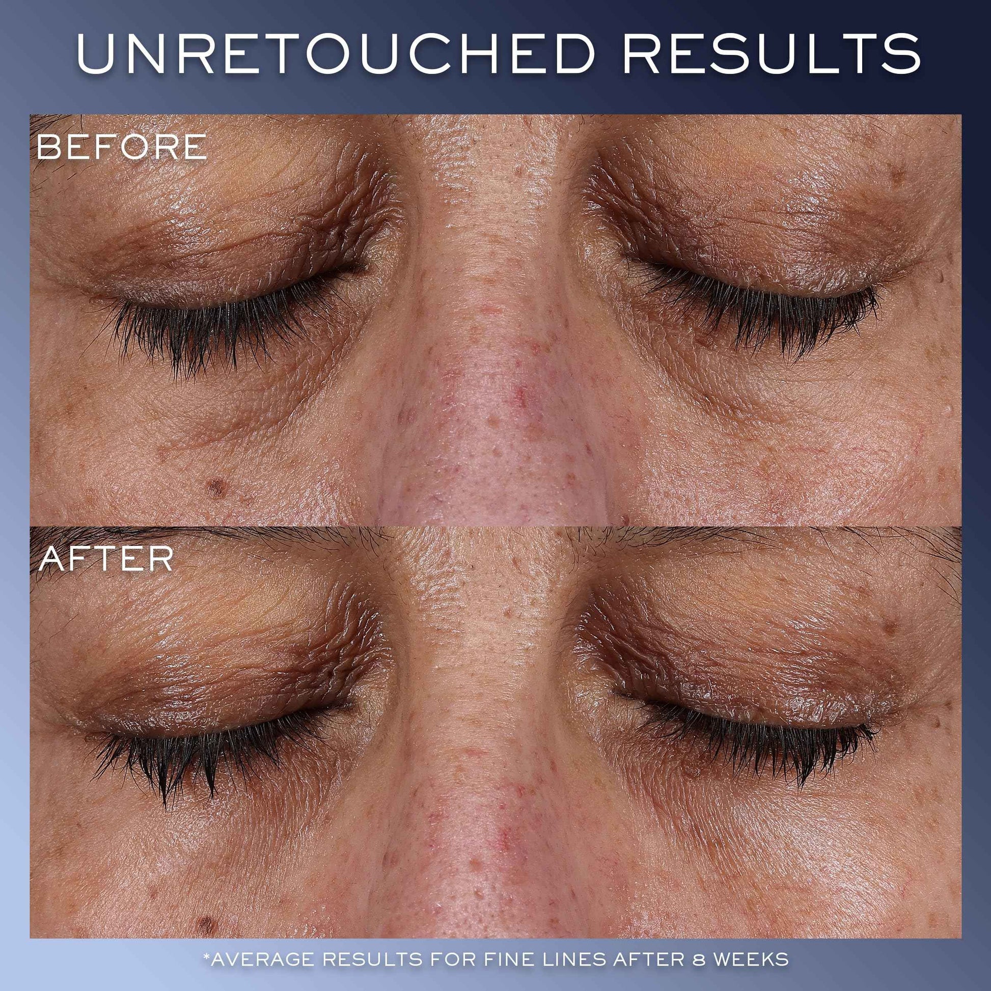 Lancôme Génifique Eye Cream - For Dark Circles & Fine Lines - With Bifidus Prebiotic, Hyaluronic Acid & Vitamin Cg - 0.67 Fl Oz