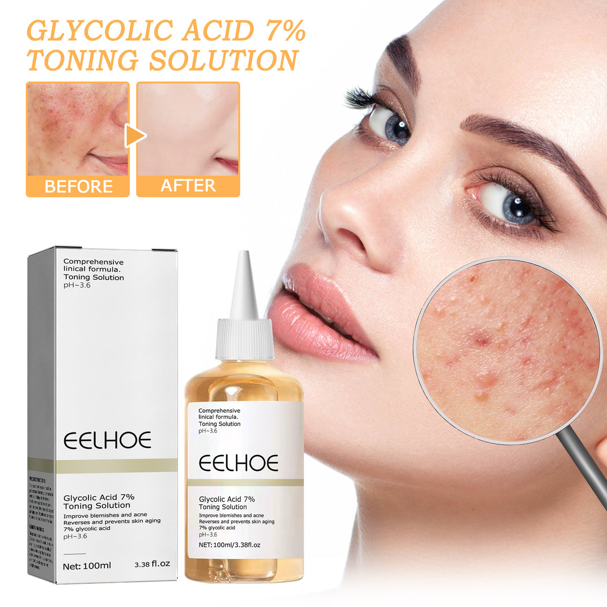 Glycolic Acid 7% Facial Lotion for Acne, 100ml - Moisturizing & Exfoliating