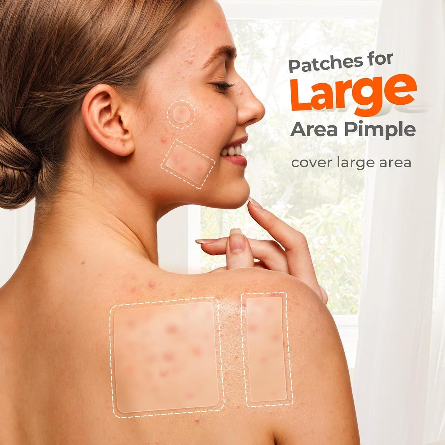 Acne Cover Patch Set 302 Pieces - Clear Skin Pimple Treatment