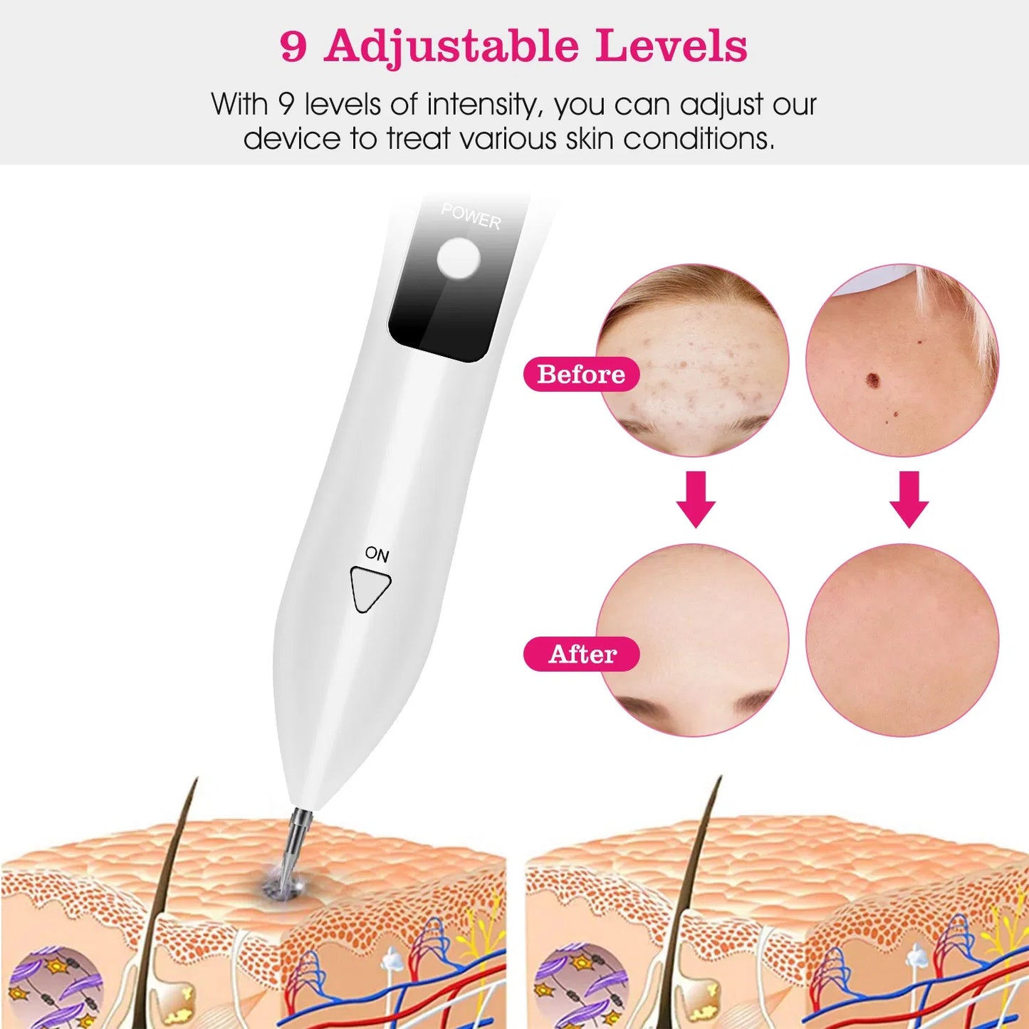 Skin Tag and Mole Removal Pen - 9 Adjustable Intensity Levels, USB Rechargeable