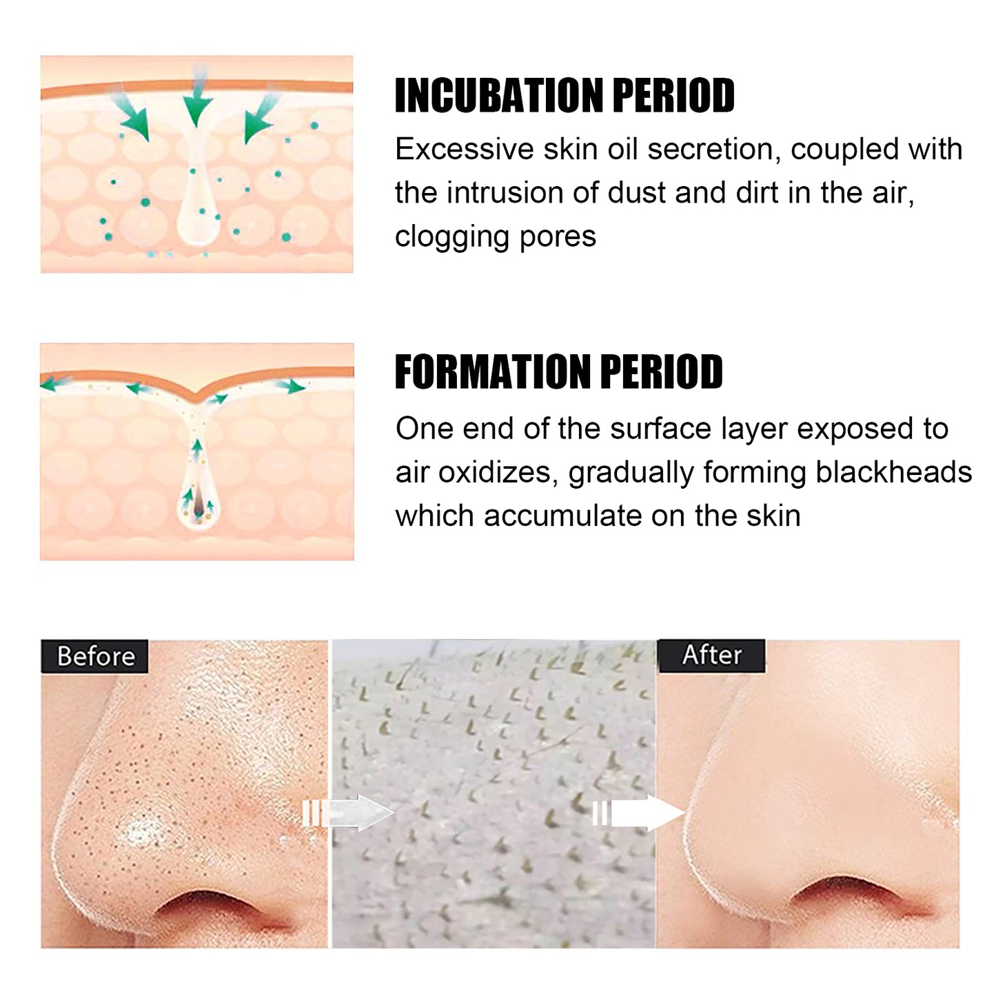 Blackhead Remover Cream Kit with 40 Pore Strips for Deep Pore Cleansing