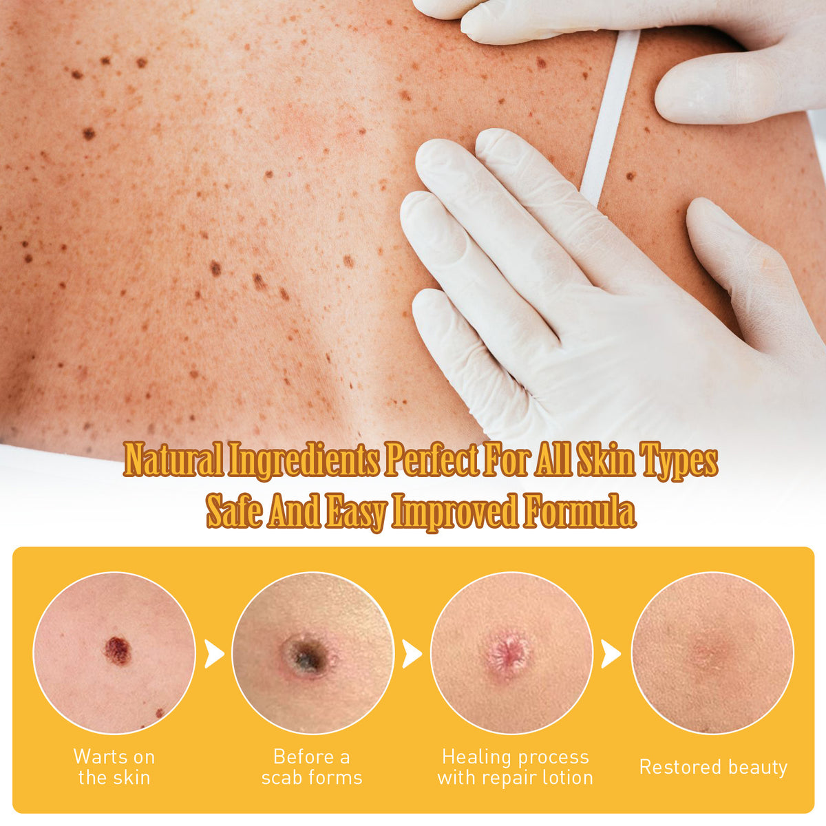 Liquid Skin Wart Removal Pen 3ML - Gentle Mole & Skin Mark Remover