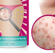 Hip and Leg Acne Moisturizing Cream - 50ml Body Care for Skin Relief
