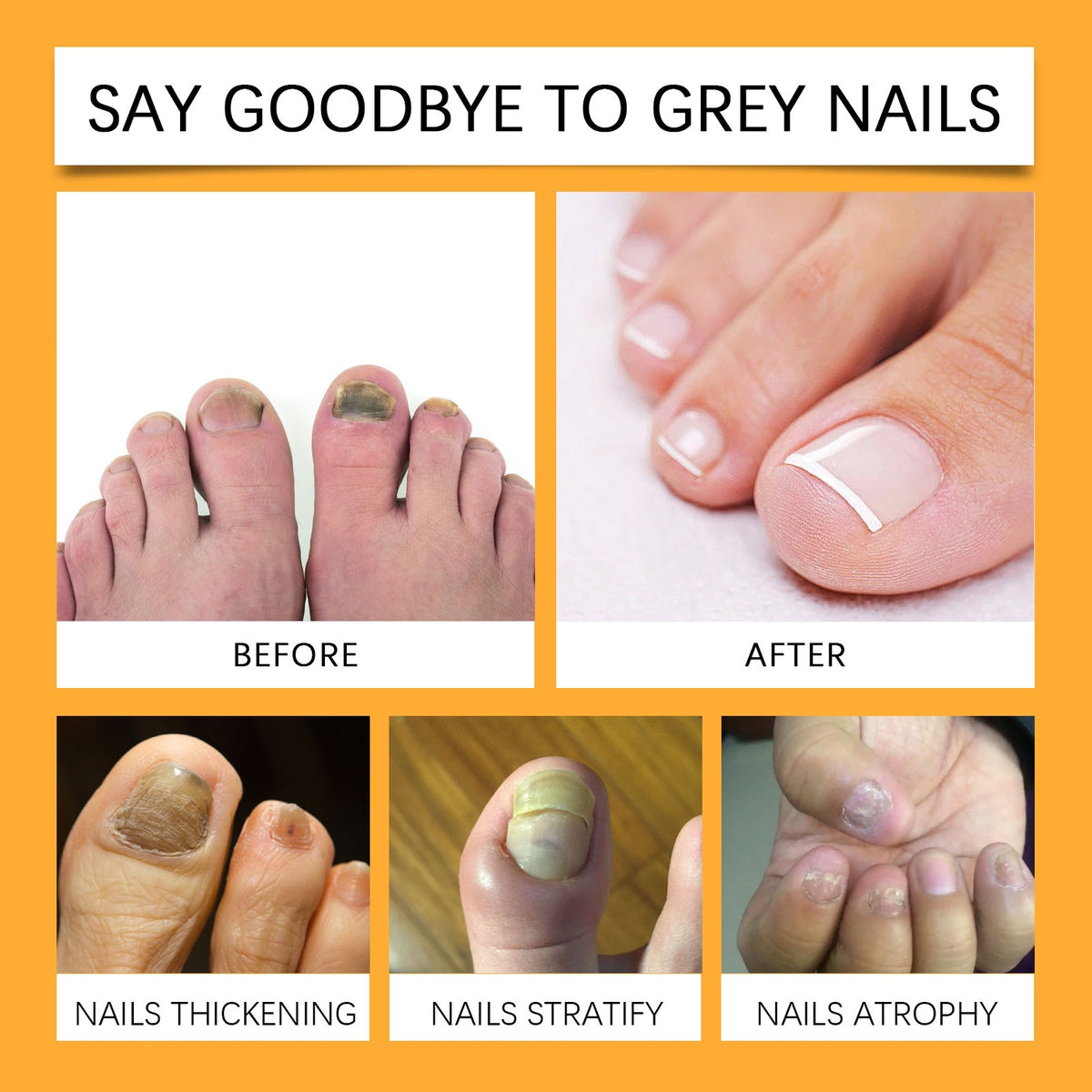 Hand And Foot Nail Fungus Cleansing Repairing, Softening Brightening