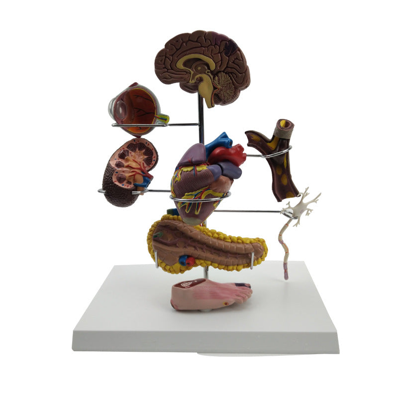 Diabetes Pathology Teaching Model - Medical Education Demonstration Tool