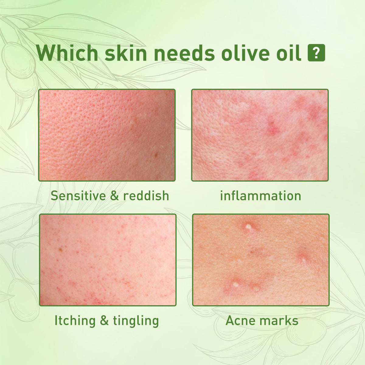 Acne Face Oil - Gentle Moisturizer for Acne Marks & Pit Repair 30ml