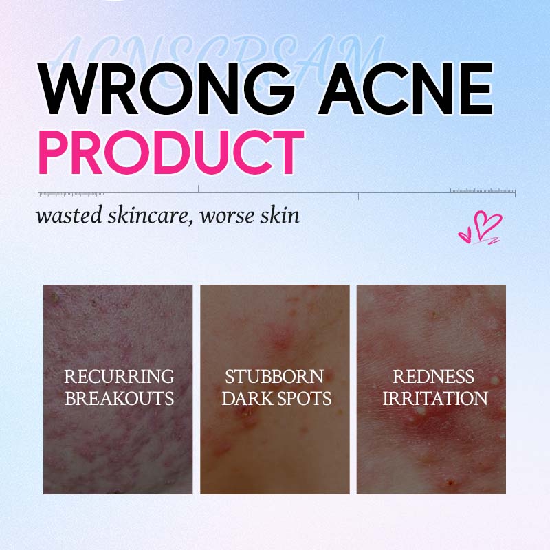 Acne Cream 7g - Alcohol-Free Spot Treatment