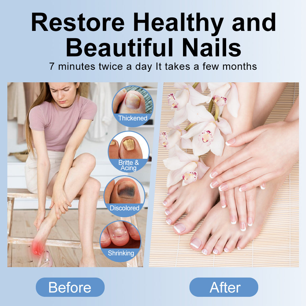 LED Nail Treatment Device for Discolored & Thickened Nails - White