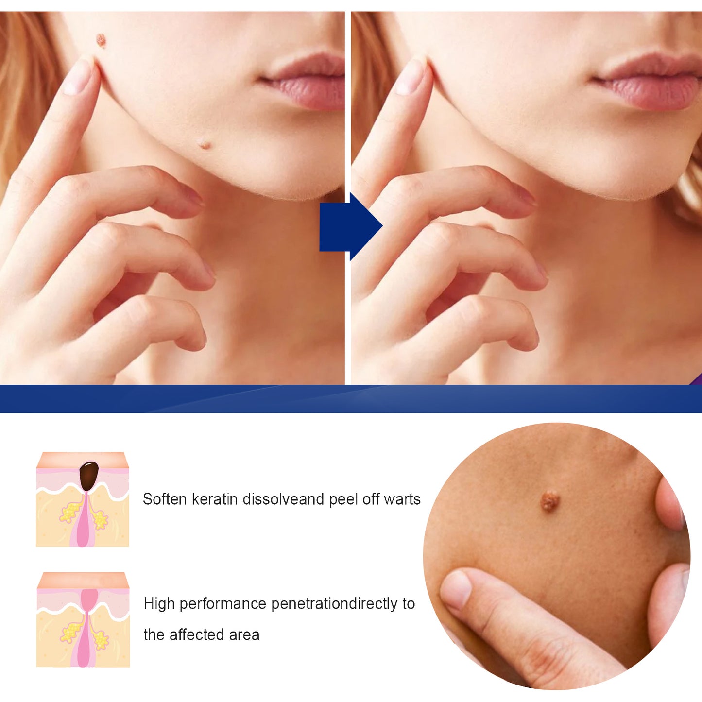 Skin Smoothing & Rejuvenating Body Cream for Wart and Spot Removal