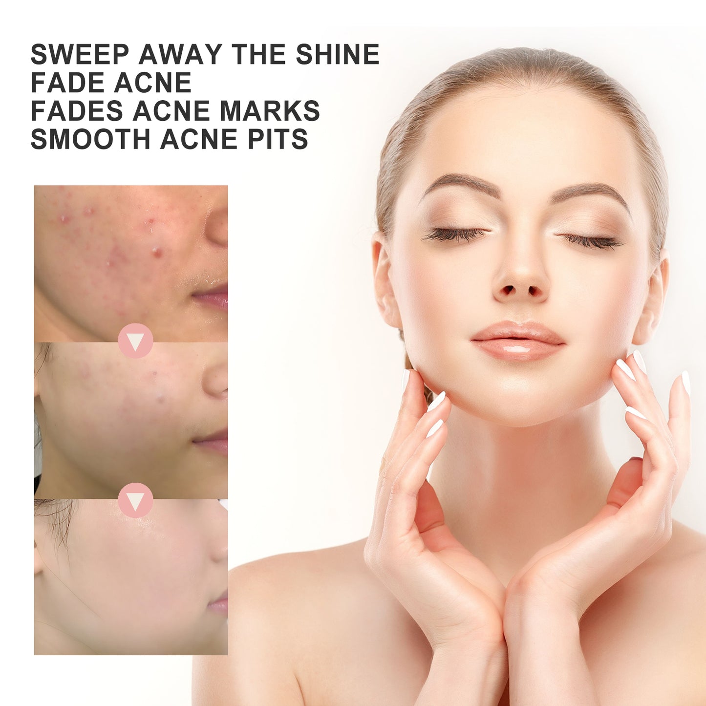 Acne Pimple Patch with Hyaluronic Acid & Vitamin B5 for Pore Cleansing