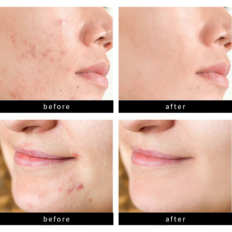 Hydrocolloid Acne Patches - 72 Count Nighttime Spot Stickers for Face