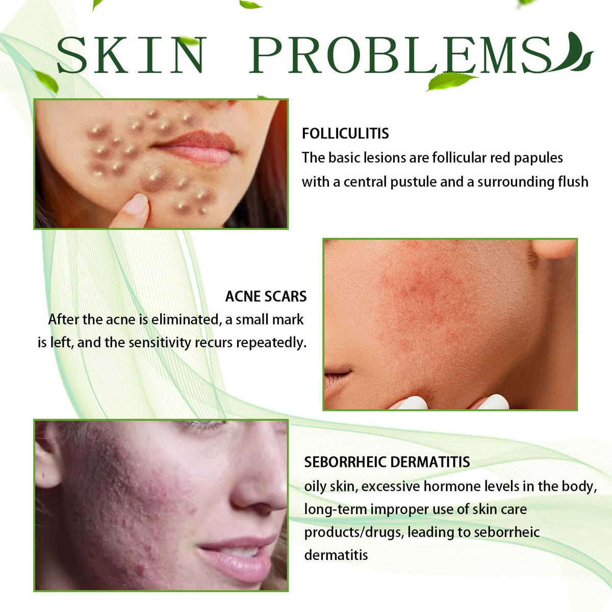 Acne Spot Treatment Cream with Tea Tree Oil - 30g Facial Acne Care
