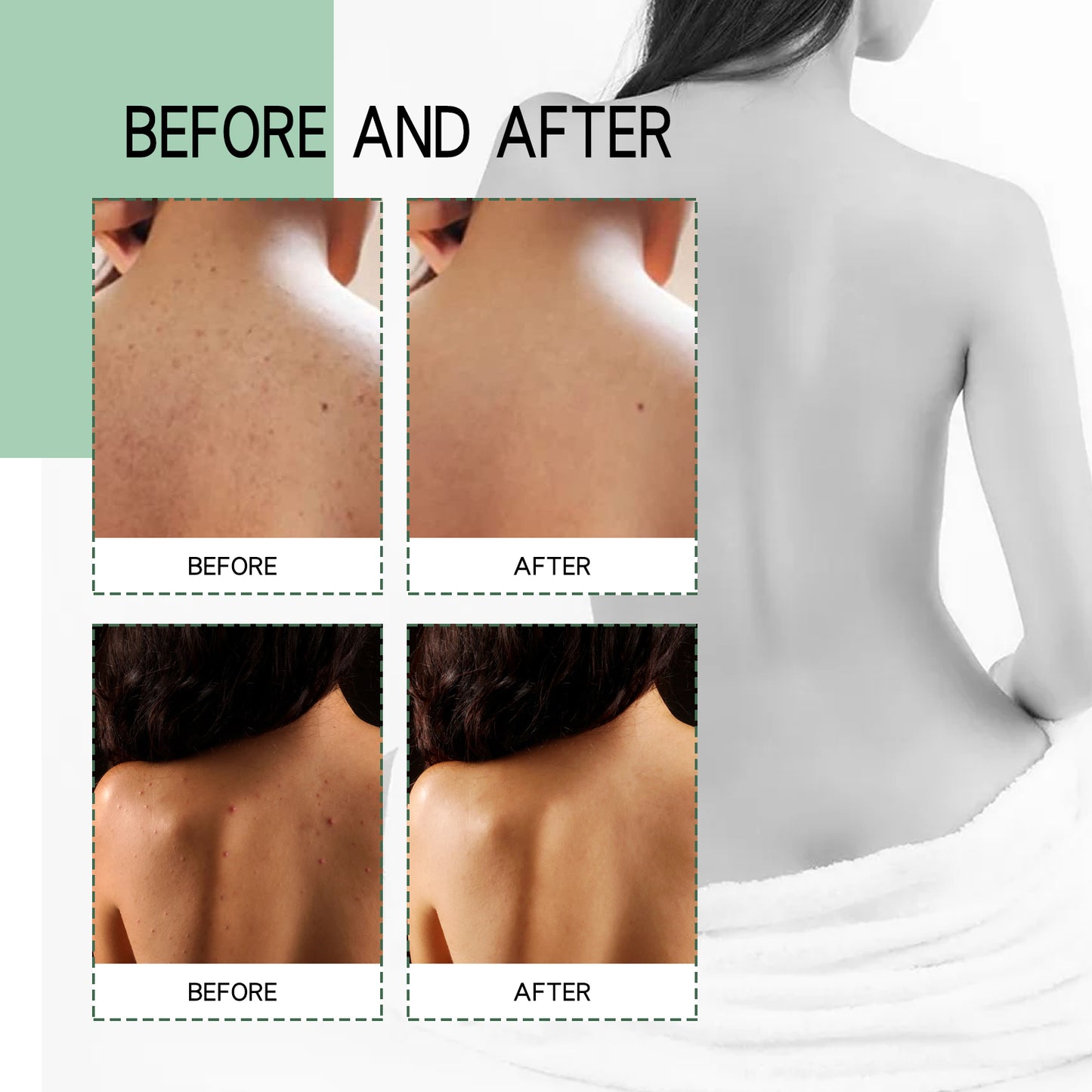 Back Acne Repair Treatment Spray - Salicylic Acid Body Acne Clearing Mist