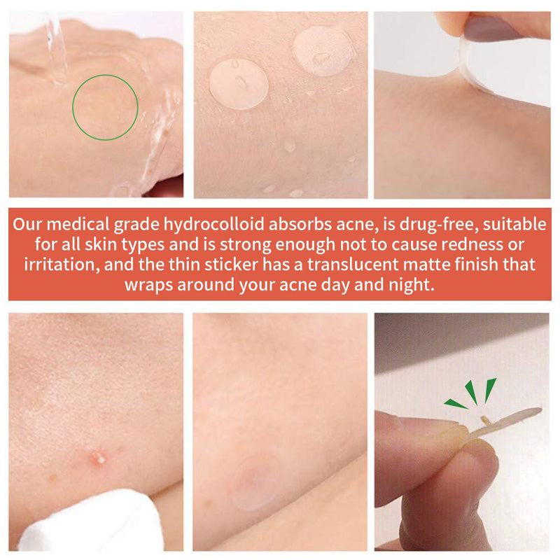 Hydrocolloid Acne Patches - 72 Count Nighttime Spot Stickers for Face