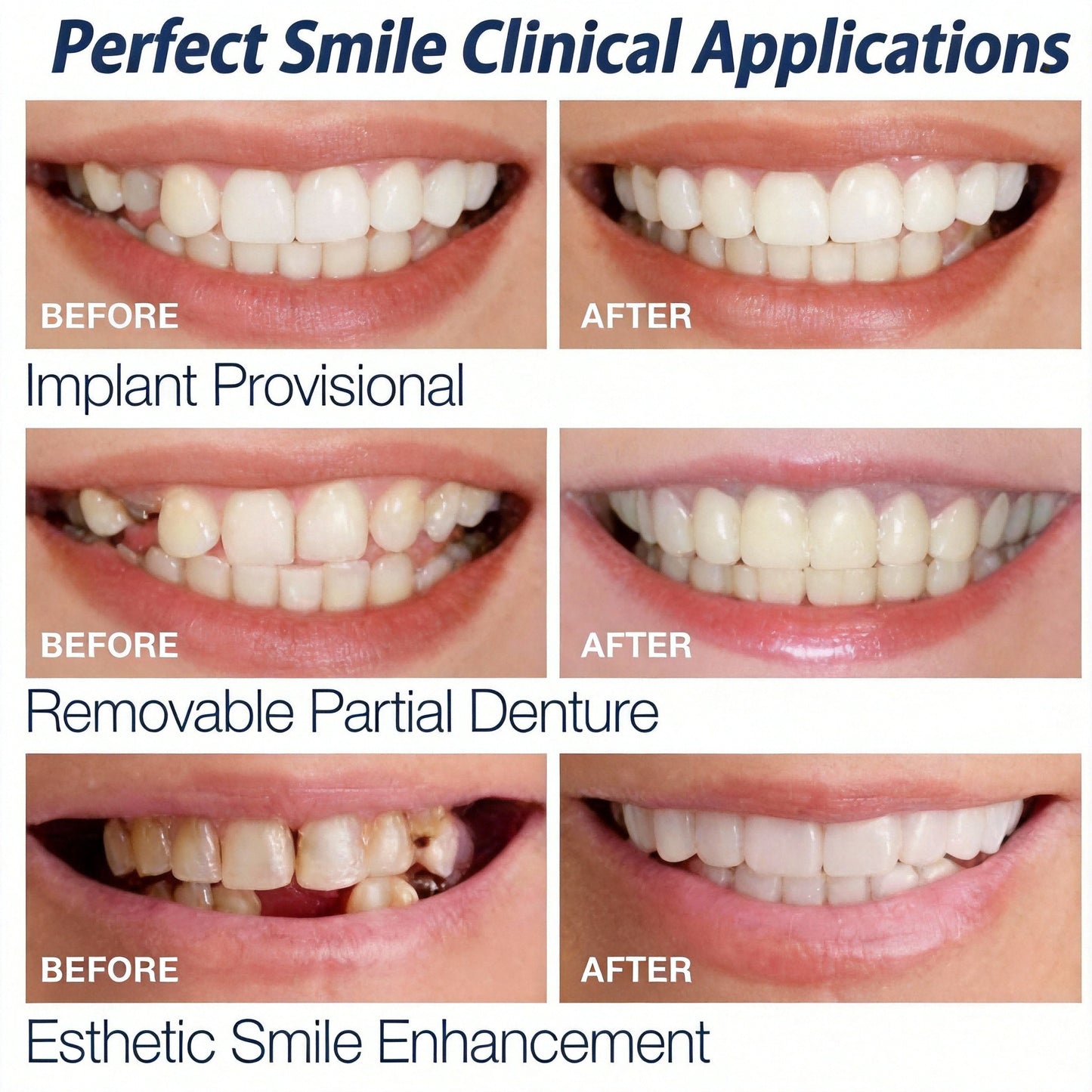 Comfortable Silicone Cosmetic Veneers for Dentures - White