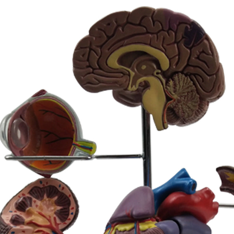 Diabetes Pathology Teaching Model - Medical Education Demonstration Tool